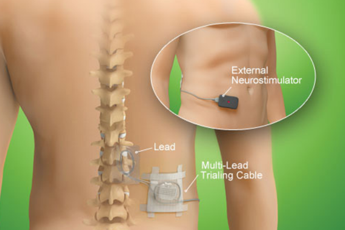 dorsal column stimulator implant