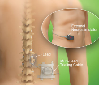 Dorsal Column Stimulators