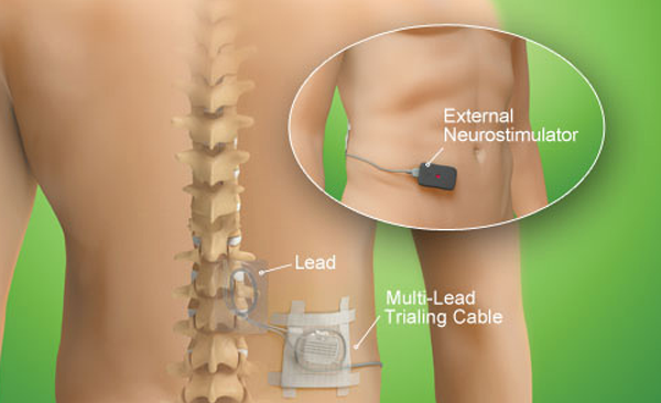 dorsal column stimulator for pain control