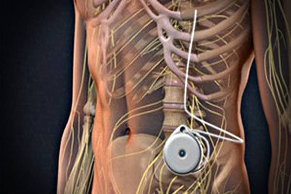 Morphine Pump Implantation